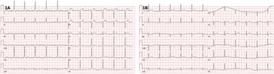 Case Report: Pulsed field ablation for epicardial right-sided accessory pathway